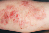 VAIL BON JIE YANG WAN (eczema, itch)